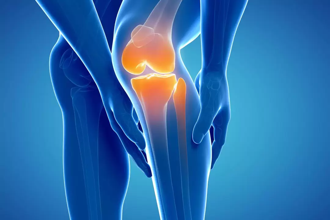 Заболевание коленного сустава (заболевание коленного сустава, деформация остеоартроза)